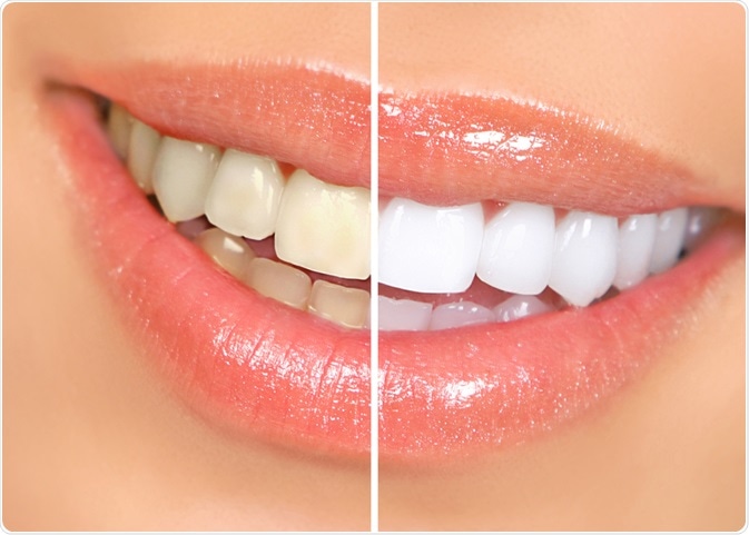 Ceramic Braces